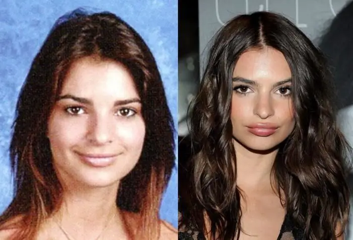 emily ratajkowski antes y después de la cirugía plástica